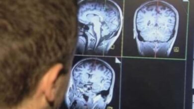 صورة دراسة.. السكتة الدماغية قد تتسبب بوفاة 10 ملايين شخص بحلول 2050