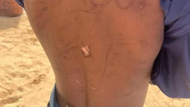 صورة نشطاء يتداولون صورا مؤلمة لطفل تظهر آثار التعذيب على جسده ويطالبون الجهات المعنية التدخل